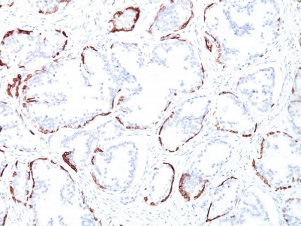 Formalin-fixed, paraffin-embedded human Prostate Carcinoma stained with Cytokeratin, HMW Mouse Monoclonal Antibody (34BE12).