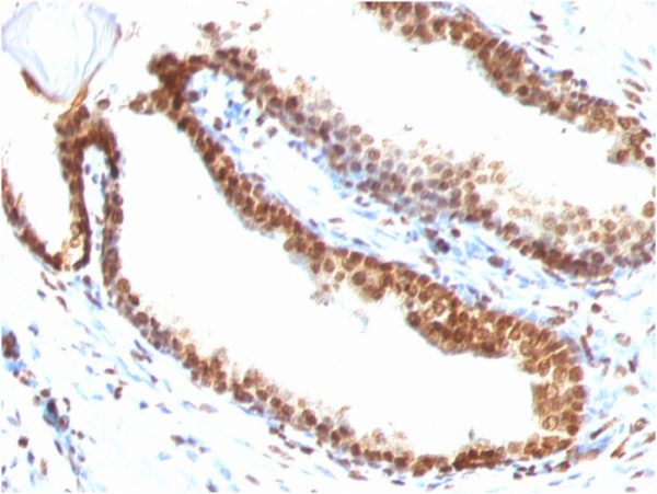 Formalin-fixed, paraffin-embedded human Colon Carcinoma stained with Double Stranded DNA Mouse Monoclonal Antibody (DSD/958)