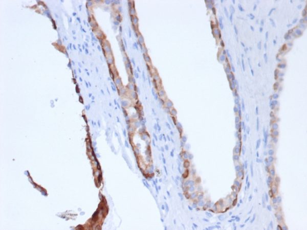 Formalin-fixed, paraffin-embedded human Prostate stained with Pan-Cytokeratin Recombinant Mouse Monoclonal Antibody (rPCK/6750).