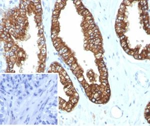 Formalin-fixed, paraffin-embedded human prostate carcinoma stained with Cytokeratin 8/18 Recombinant Rabbit Monoclonal Antibody (KRT8.18/4997R). Inset: PBS instead of primary antibody; secondary only negative control.