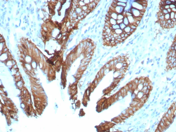 Formalin-fixed, paraffin-embedded human colon stained with Cadherin 17 Recombinant Mouse Monoclonal Antibody (rCDH17/8512). HIER: Tris/EDTA, pH9.0, 45min. 2°C: HRP-polymer, 30min. DAB, 5min.