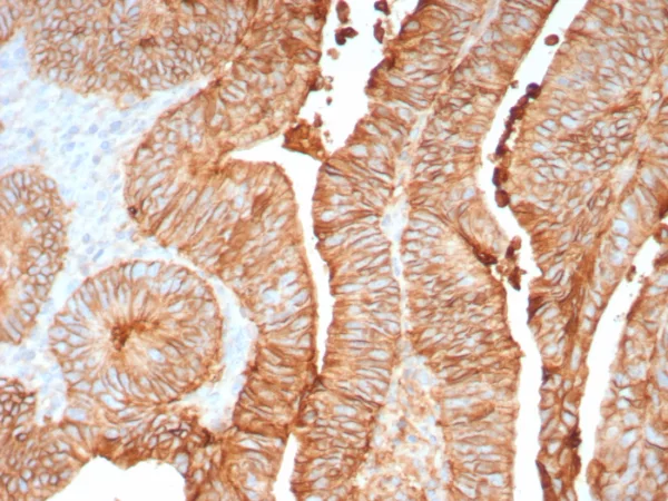 Formalin-fixed, paraffin-embedded human colon stained with CDH17 Recombinant Rabbit Monoclonal Antibody (CDH17/8158R). Inset: PBS instead of primary antibody; secondary only negative control.