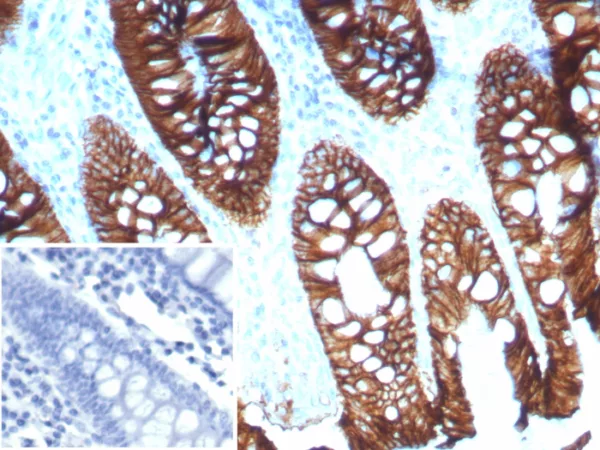 Formalin-fixed, paraffin-embedded human colon stained with CDH17 Recombinant Rabbit Monoclonal Antibody (CDH17/8515R). Inset: PBS instead of primary antibody; secondary only negative control.