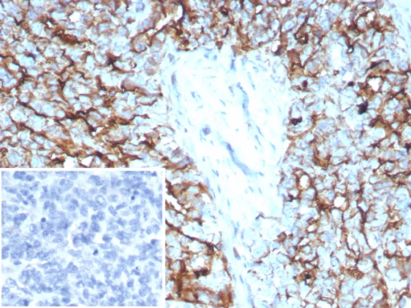Formalin-fixed, paraffin-embedded human ovarian cancer stained with Mesothelin Recombinant Rabbit Monoclonal Ab (MSLN/8391R). Inset: PBS instead of primary antibody; secondary only negative control.