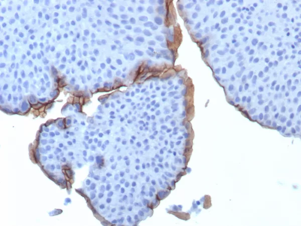 Formalin-fixed, paraffin-embedded human bladder stained with Uroplakin 3B Mouse Monoclonal Antibody (UPK3B/3270). HIER: Tris/EDTA, pH9.0, 45min. 2°C: HRP-polymer, 30min. DAB, 5min.