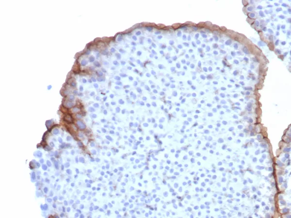Formalin-fixed, paraffin-embedded human bladder stained with Uroplakin 3B Recombinant Rabbit Monoclonal Antibody (UPK3B/8550R). HIER: Tris/EDTA, pH9.0, 45min. 2°C: HRP-polymer, 30min. DAB, 5min.