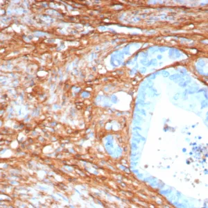 Formalin-fixed, paraffin-embedded human colon stained with Periostin Recombinant Rabbit Monoclonal Antibody (POSTN/8165R). HIER: Tris/EDTA, pH9.0, 45min. 2°C: HRP-polymer, 30min. DAB, 5min.