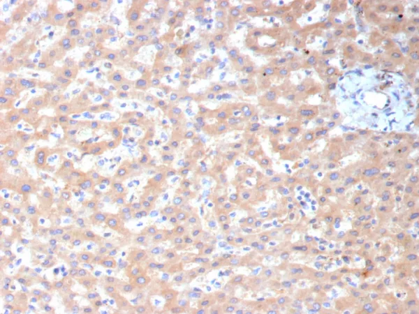 Formalin-fixed, paraffin-embedded human hepatocellular carcinoma stained with ADH1L1 Mouse Monoclonal Antibody (ALDH1L1/7959). HIER: Tris/EDTA, pH9.0, 45min. 2°C: HRP-polymer, 30min. DAB, 5min.