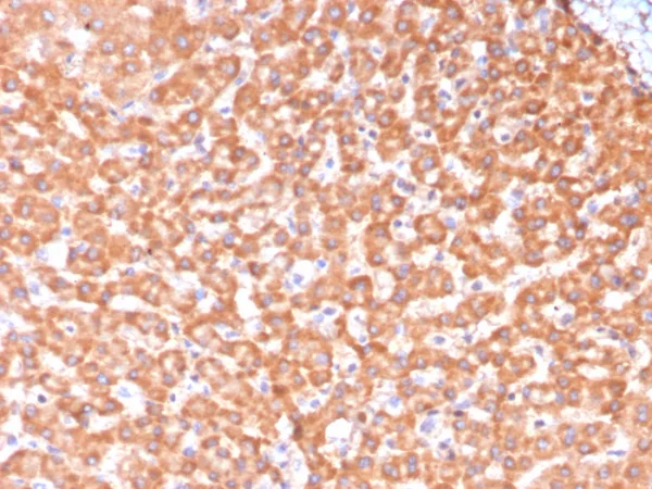 Formalin-fixed, paraffin-embedded human hepatocellular carcinoma stained with ADH1L1 Mouse Monoclonal Antibody (ALDH1L1/7969). HIER: Tris/EDTA, pH9.0, 45min. 2°C: HRP-polymer, 30min. DAB, 5min.