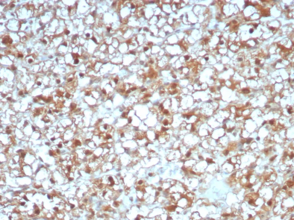 Formalin-fixed, paraffin-embedded human renal cell carcinoma stained with ADH1L1 Mouse Monoclonal Antibody (ALDH1L1/7969). HIER: Tris/EDTA, pH9.0, 45min. 2°C: HRP-polymer, 30min. DAB, 5min.