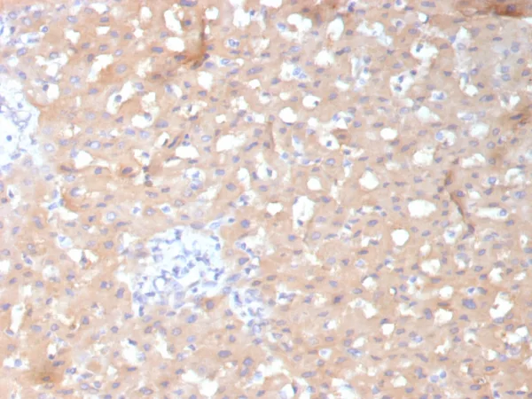 Formalin-fixed, paraffin-embedded human hepatocellular carcinoma stained with ADH1L1 Mouse Monoclonal Antibody (ALDH1L1/7970). HIER: Tris/EDTA, pH9.0, 45min. 2°C: HRP-polymer, 30min. DAB, 5min.