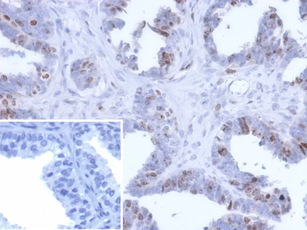 Formalin-fixed, paraffin-embedded human prostate carcinoma stained with BATF2 Mouse Monoclonal Antibody (PCRP-BATF2-2B9). Inset: PBS instead of primary antibody; secondary only negative control.