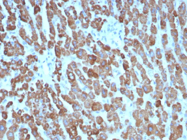 Formalin-fixed, paraffin-embedded human hepatocellular carcinoma stained with CPS1 Mouse Monoclonal Antibody (CPS1/8416). HIER: Tris/EDTA, pH9.0, 45min. 2°C: HRP-polymer, 30min. DAB, 5min.