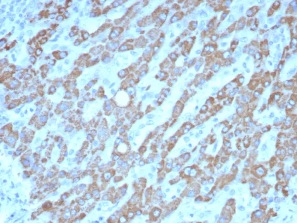 Formalin-fixed, paraffin-embedded human hepatocellular carcinoma stained with CPS1 Mouse Monoclonal Antibody (CPS1/8420). HIER: Tris/EDTA, pH9.0, 45min. 2°C: HRP-polymer, 30min. DAB, 5min.