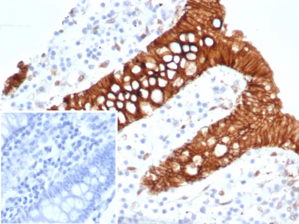 Formalin-fixed, paraffin-embedded human colon carcinoma stained with S100A16 Mouse Monoclonal Antibody (S100A16/7412). Inset: PBS instead of primary antibody; secondary only negative control.