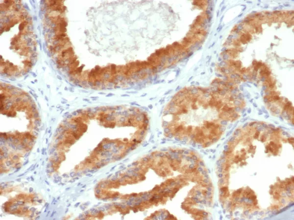 Formalin-fixed, paraffin-embedded human prostate cancer stained with CREB3L4 Mouse Monoclonal Antibody (PCRP-CREB3L4-1A3). HIER: Tris/EDTA, pH9.0, 45min. 2°C: HRP-polymer, 30min. DAB, 5min.