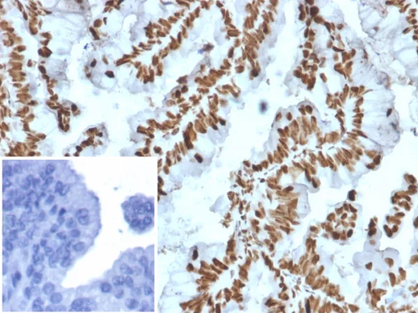 Formalin-fixed, paraffin-embedded human prostate carcinoma stained with ZNF690 / ZSCAN29 Mouse Monoclonal Antibody (PCRP-ZNF846-1E12). Inset: PBS instead of primary antibody; secondary only negative control.