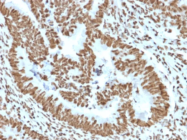 Formalin-fixed, paraffin-embedded human colon carcinoma stained with ZNF690 / ZSCAN29 Mouse Monoclonal Antibody (PCRP-ZNF846-1E12). HIER: Tris/EDTA, pH9.0, 45min. 2°C: HRP-polymer, 30min. DAB, 5min.