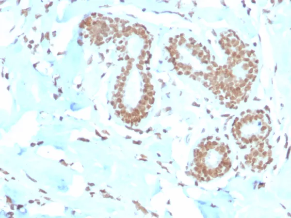 Formalin-fixed, paraffin-embedded human breast carcinoma stained with  E2F4 Mouse Monoclonal Antibody (E2F4/4224). HIER: Tris/EDTA, pH9.0, 45min. 2°C: HRP-polymer, 30min. DAB, 5min.