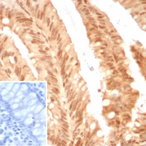 Formalin-fixed, paraffin-embedded human colon cancer stained with  E2F4 Recombinant Rabbit Monoclonal Antibody (E2F4/8811R). HIER: Tris/EDTA, pH9.0, 45min. 2°C: HRP-polymer, 30min. DAB, 5min.