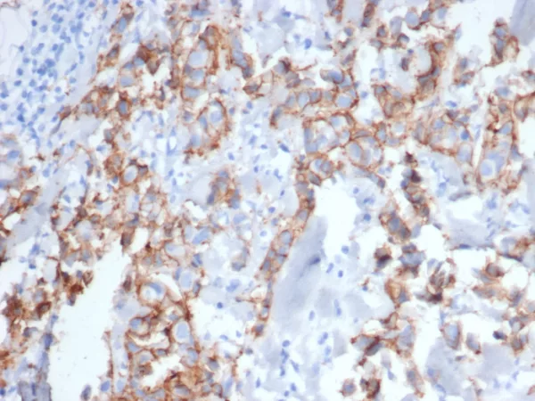 IHC analysis of formalin-fixed, paraffin-embedded human breast carcinoma. Stained using ERBB2/6637 at 2ug/ml in PBS for 30min RT. HIER: Tris/EDTA, pH9.0, 45min. 2°C: HRP-polymer, 30min. DAB, 5min.