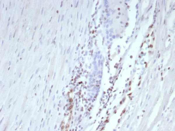 Formalin-fixed, paraffin-embedded human prostate stained with ERG Recombinant Rabbit Monoclonal Antibody (ERG/9122R) at 2ug/ml. HIER: Tris/EDTA pH 9; 95°C/45min. 2°CAb: HRP-Polymer:30mins; DAB: 5min.