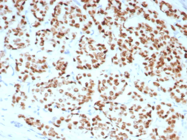 Formalin fixed paraffin embedded human breast carcinoma stained with ER, alpha Recombinant Mouse Monoclonal Antibody (rESR1/8761). HIER: Tris/EDTA, pH9.0, 45min. 2°C: HRP-polymer, 30min. DAB, 5min