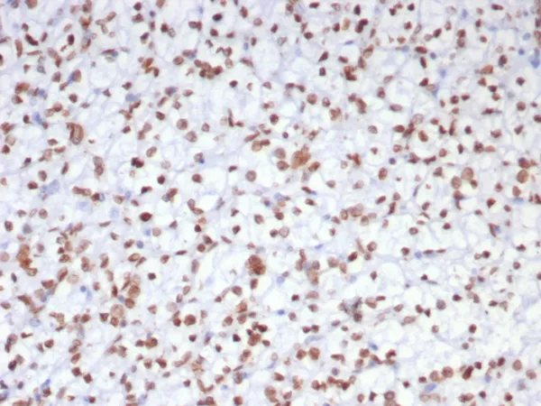 Formalin-fixed, paraffin-embedded human renal cell carcinoma stained with EZH2 / KMT6 Mouse Monoclonal Antibody (EZH2/7507). HIER: Tris/EDTA, pH9.0, 45min. 2°C: HRP-polymer, 30min. DAB, 5min.