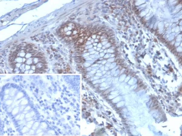 Formalin-fixed, paraffin-embedded human colon carcinoma stained with EZH2 / KMT6 Mouse Monoclonal Antibody (EZH2/4194). Inset: PBS instead of primary antibody; secondary only negative control.