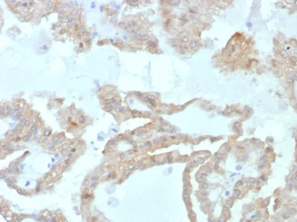 Formalin-fixed, paraffin-embedded human renal cell carcinoma stained with FABP2 Mouse Monoclonal Antibody (FABP2/7669). HIER: Tris/EDTA, pH9.0, 45min. 2: HRP-polymer, 30min. DAB, 5min.