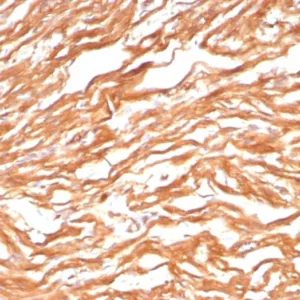 Formalin-fixed, paraffin-embedded human heart stained with FABP3 Mouse Monoclonal Antibody (FABP3/8443). HIER: Tris/EDTA, pH9.0, 45min. 2°C: HRP-polymer, 30min. DAB, 5min.