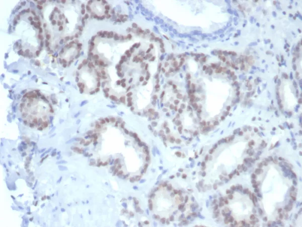 Formalin-fixed, paraffin-embedded human prostate stained with Fli1 Mouse Monoclonal Antibody (FLI1/7508). HIER: Tris/EDTA, pH9.0, 45min. 2°C: HRP-polymer, 30min. DAB, 5min.