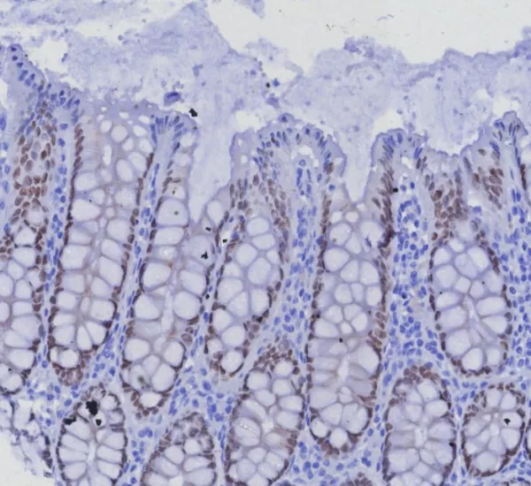 IHC analysis of formalin-fixed, paraffin-embedded human colon carcinoma.  Strong nuclear staining using SATB2/7488 at 2ug/ml in PBS for 30min RT. Inset: PBS instead of primary antibody; secondary only negative control.