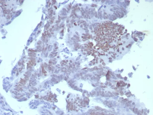 Formalin-fixed, paraffin-embedded human colon carcinoma stained with SATB2 Rabbit Recombinant Monoclonal Antibody (SATB2/8264R). HIER: Tris/EDTA, pH9.0, 45min. 2°C: HRP-polymer, 30min. DAB, 5min.