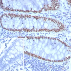 Formalin-fixed, paraffin-embedded human colon carcinoma stained with SATB2 Rabbit Recombinant Monoclonal Antibody (SATB2/8292R). Inset: PBS instead of primary antibody; secondary only negative control