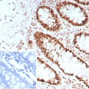 Formalin-fixed, paraffin-embedded human colon carcinoma stained with SATB2 Rabbit Recombinant Monoclonal Antibody (SATB2/8697R). Inset: PBS instead of primary antibody, secondary negative control.
