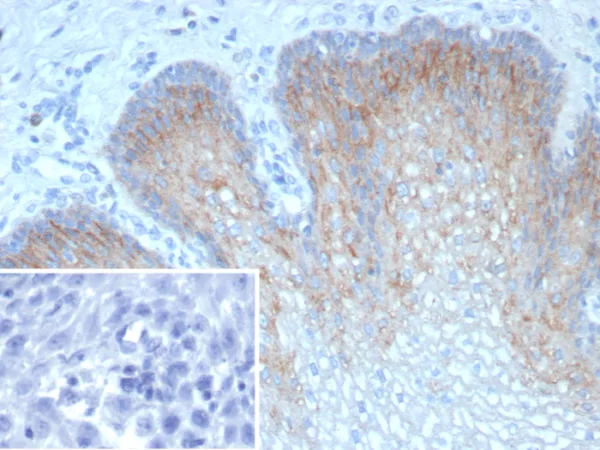 Formalin-fixed, paraffin-embedded human esophagus stained with TRIM29 Recombinant Rabbit Monoclonal Antibody (TRIM29/9256R). Inset: PBS instead of primary antibody; secondary only negative control.