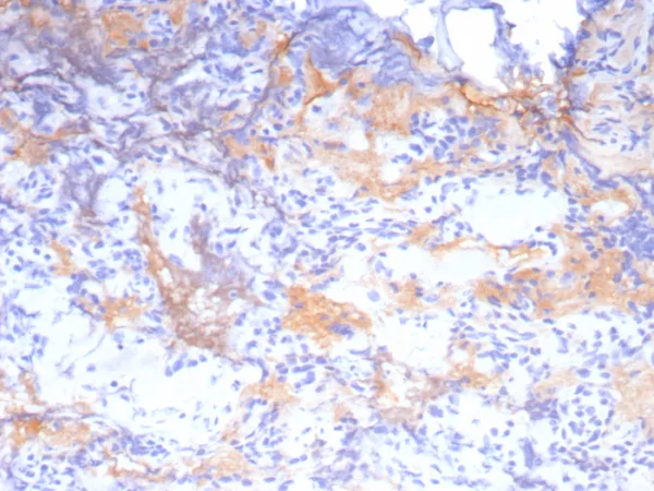 Formalin-fixed, paraffin-embedded human pituitary stained with Growth Hormone Recombinant Rabbit Monoclonal Antibody (GH/8215R). HIER: Tris/EDTA, pH9.0, 45min. 2: HRP-polymer, 30min. DAB, 5min.