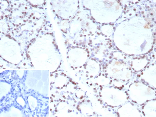 Formalin-fixed, paraffin-embedded human prostate carcinoma stained with FOXP1 Recombinant Rabbit Monoclonal Antibody (FOXP1/9381R). Inset: PBS instead of primary antibody; secondary only negative control.