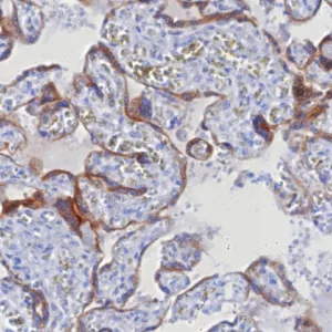 Formalin-fixed, paraffin-embedded human hepatocellular carcinoma stained with Glypican-3 Recombinant Rabbit Monoclonal Antibody (GPC3/8127R). HIER: Tris/EDTA, pH9.0, 45min. 2: HRP-polymer, 30min. DAB, 5min.