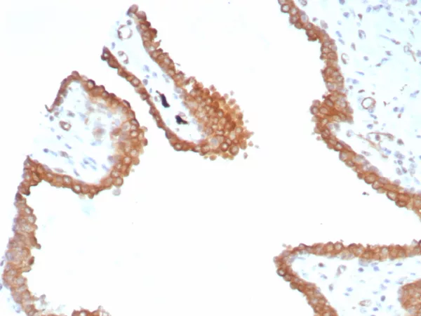 Formalin-fixed, paraffin-embedded human prostate stained with GLUL Recombinant Rabbit Monoclonal Antibody (GLUL/8517R). HIER: Tris/EDTA, pH9.0, 45min. 2°C: HRP-polymer, 30min. DAB, 5min.