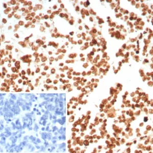 Formalin-fixed, paraffin-embedded human ovarian carcinoma stained with Histone Recombinant Mouse Monoclonal Antibody (rHH1/8702). Inset: PBS instead of primary antibody; secondary only negative control.