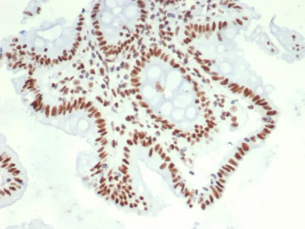 Formalin-fixed, paraffin-embedded human colon carcinoma stained with HDGF Mouse Monoclonal Antibody (PCRP-HDGF-1D1). HIER: Tris/EDTA, pH9.0, 45min. 2°C: HRP-polymer, 30min. DAB, 5min.