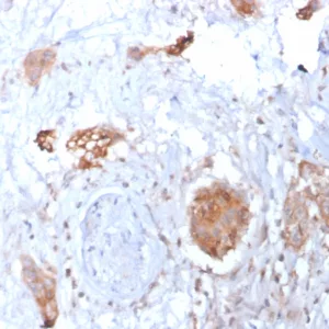 Formalin-fixed, paraffin-embedded human breast carcinoma stained with HIF1 alpha Mouse Monoclonal Antibody (HIF1A/3248). Inset: PBS instead of primary antibody; secondary only negative control.
