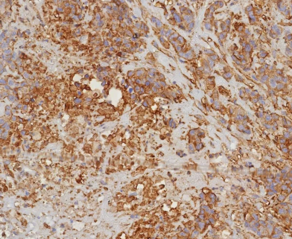 Formalin-fixed, paraffin-embedded human bladder carcinoma stained with HLA-G Recombinant Rabbit Monoclonal Antibody (HLAG/8344R). HIER: Tris/EDTA, pH9.0, 45min. 2: HRP-polymer, 30min. DAB, 5min.