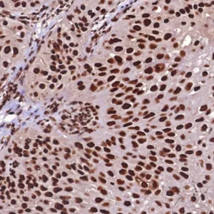 Formalin-fixed, paraffin-embedded human pT24 bladder carcinoma stained with HSPA1B Mouse Monoclonal Antibody (HSPA1B/7621). HIER: Tris/EDTA, pH9.0, 45min. 2°C: HRP-polymer, 30min. DAB, 5min.