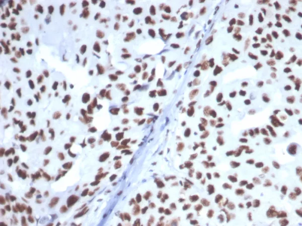 Formalin-fixed, paraffin-embedded human breast carcinoma stained with HSPA1B Mouse Monoclonal Antibody (HSPA1B/7628). HIER: Tris/EDTA, pH9.0, 45min. 2°C: HRP-polymer, 30min. DAB, 5min.