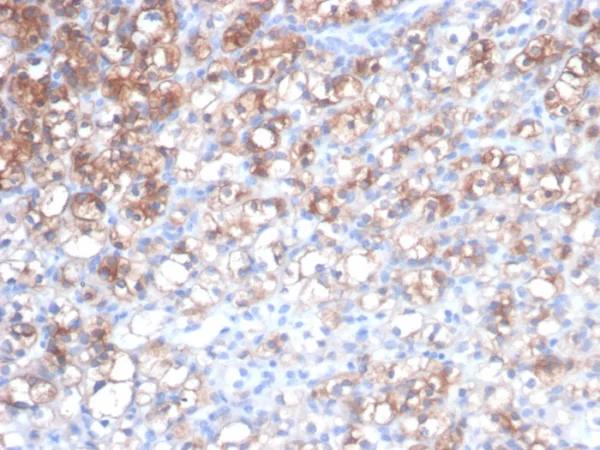 Formalin-fixed, paraffin-embedded human renal cell carcinoma stained with HSP27 Recombinant Mouse Monoclonal Antibody (rHSPB1/7298). HIER: Tris/EDTA, pH9.0, 45min. 2°C: HRP-polymer, 30min. DAB, 5min.