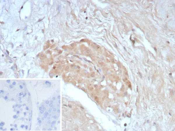 Formalin-fixed, paraffin-embedded human testis stained with Survivin Recombinant Rabbit Monoclonal Antibody (BIRC5/8936R). Inset: PBS instead of primary antibody; secondary only negative control.