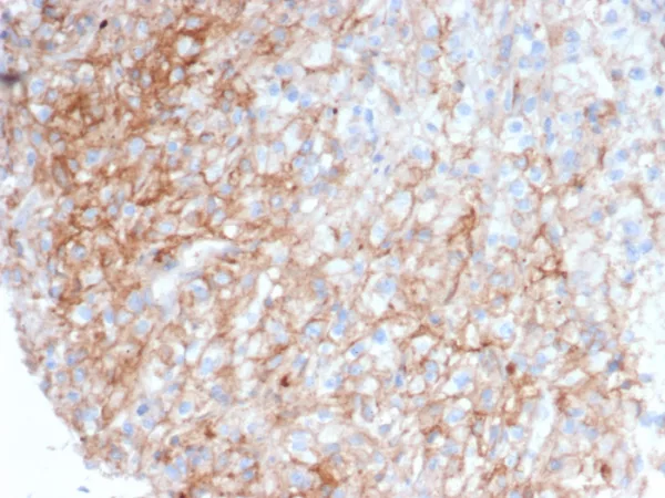 Formalin-fixed, paraffin-embedded human kidney carcinoma stained with CD54 / ICAM-1 Mouse Monoclonal Antibody (ICAM1/6968). HIER: Tris/EDTA, pH9.0, 45min. 2°C: HRP-polymer, 30min. DAB, 5min.